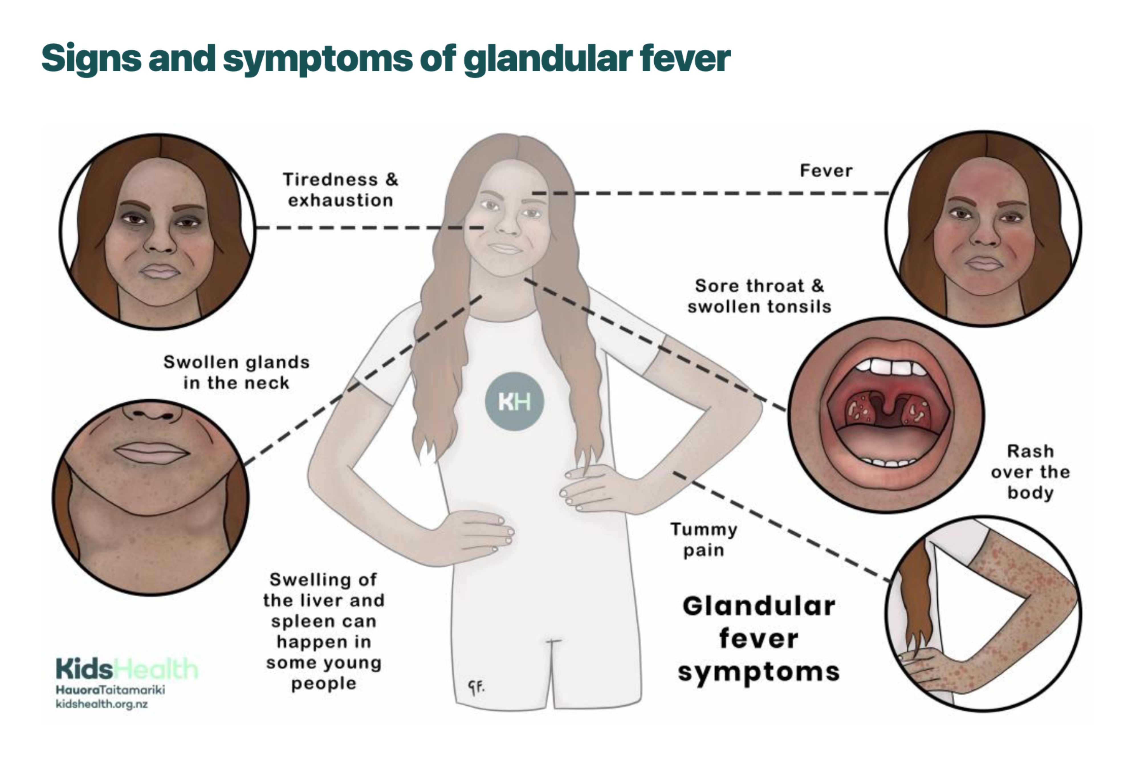 New KidsHealth Content! Glandular fever in children and young people ...